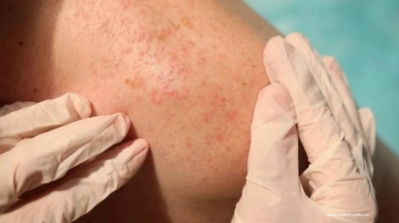 Rôm sảy hay phát ban do nhiệt là một chứng bệnh ngoài da thường gặp khi thời tiết nóng ẩm