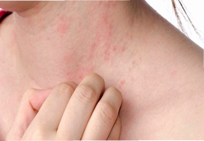 Rôm sảy ở người lớn biểu hiện bằng các nốt mụn đỏ li ti