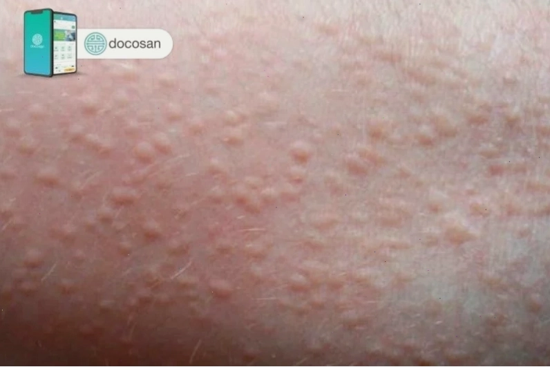 Rôm sảy ở người lớn cần được điều trị đúng cách