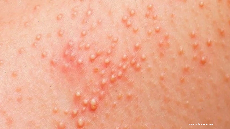 Rôm sảy sâu gây tổn thương lớp sâu nhất của hạ bì