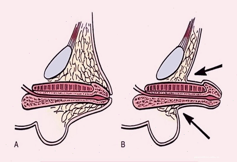 So sánh hiện tượng thụt dương (A) và dương vật bình thường (B)