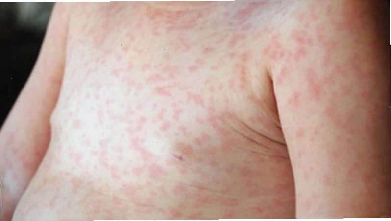 Sốt phát ban có thể gây nổi mẩn đỏ nhưng không kèm ngứa