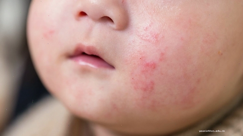 Sử dụng sữa rửa mặt dịu nhẹ giúp làm sạch da và ngăn ngừa mụn sữa