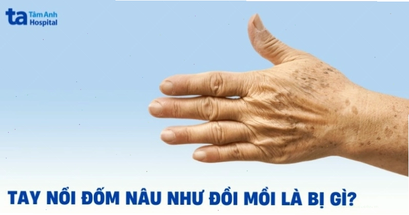 Tay nổi đốm nâu như đồi mồi cần lưu ý gì?