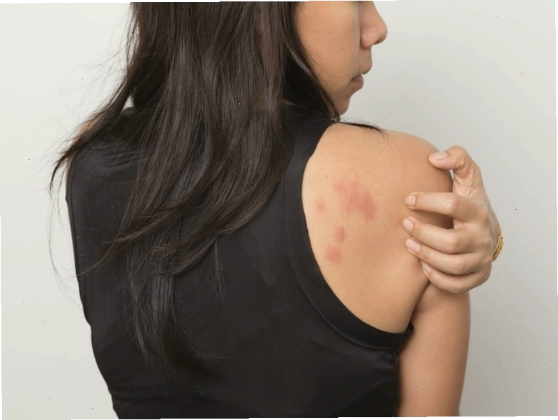 Tham khảo ý kiến bác sĩ da liễu khi bị nổi mẩn đỏ và ngứa kéo dài