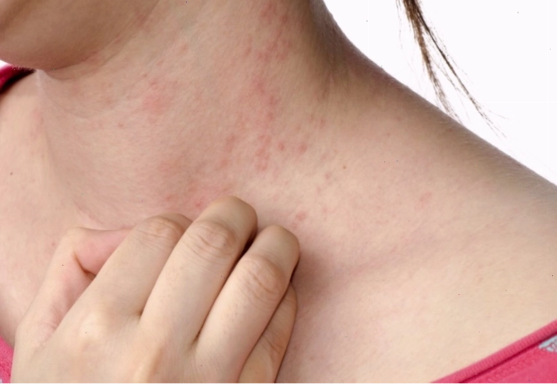 Thay đổi thời tiết là một trong những nguyên nhân gây ngứa khắp người