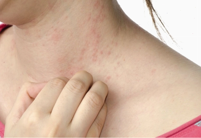 Thay đổi thời tiết là một trong những nguyên nhân phổ biến gây ngứa khắp người