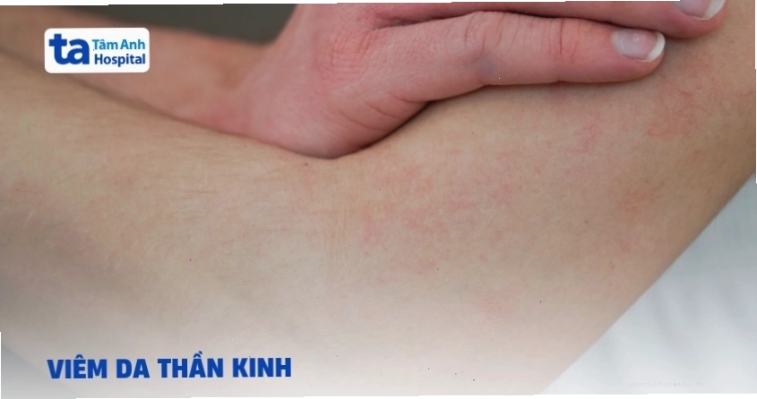 Thông tin về viêm da thần kinh và cách điều trị