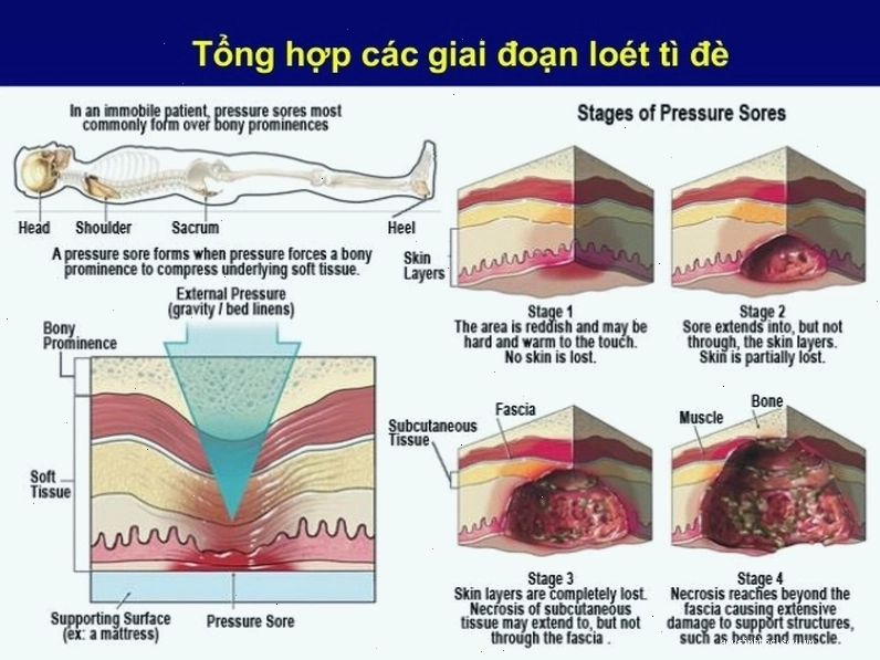 Thuốc bôi trị lở loét cho người già