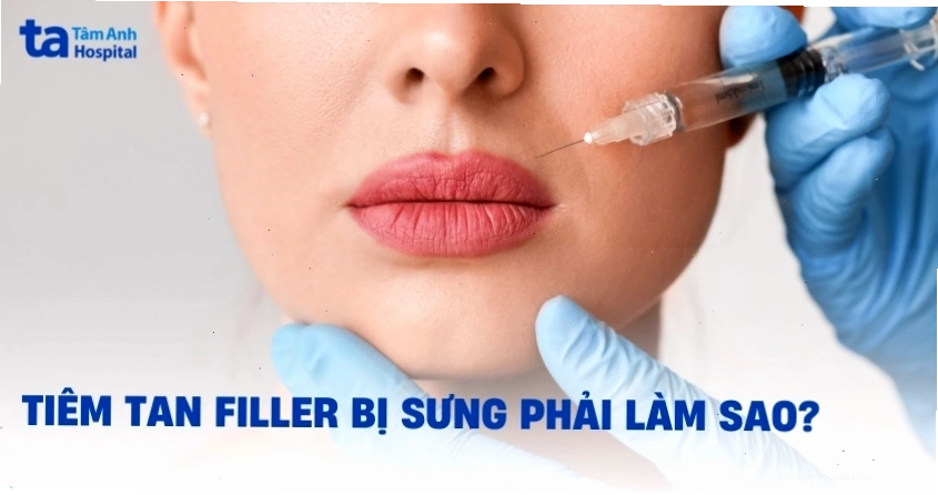 Tiêm tan filler bị sưng phải làm sao? 4 cách giảm sưng hiệu quả