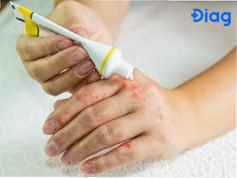 Tìm kiếm tư vấn y tế khi bị nổi mẩn đỏ ngứa