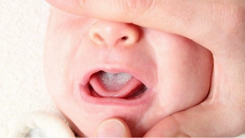 Tình trạng nấm lưỡi có thể lây lan sang các bộ phận khác của khoang miệng