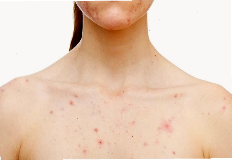 Tình trạng nổi mụn, mẩn ngứa do nóng gan gây khó chịu