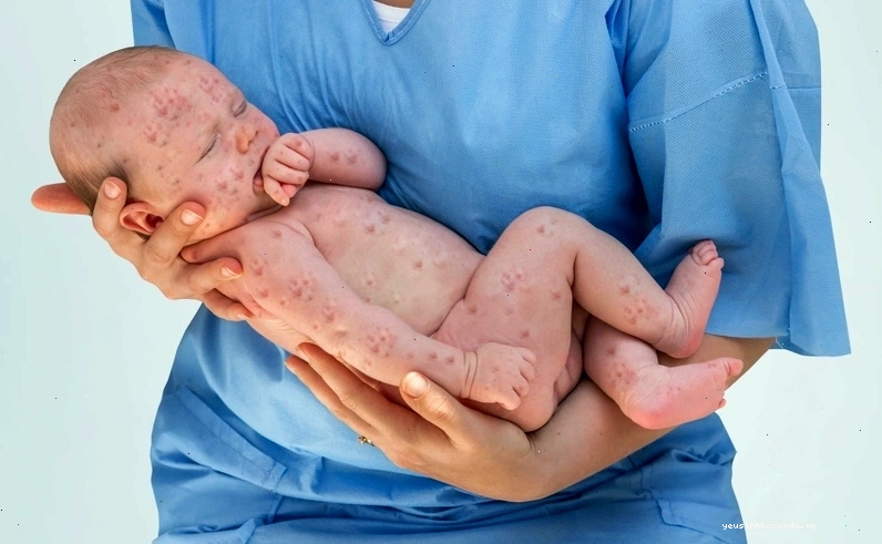 Trẻ bị nổi mẩn đỏ khắp người sau sốt có thể do nhiều nguyên nhân