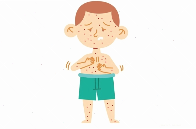 Trẻ em bị nổi mẩn đỏ ngứa khắp người gây khó chịu