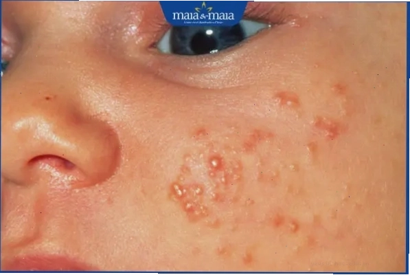 Trẻ sơ sinh bị mụn hạt kê