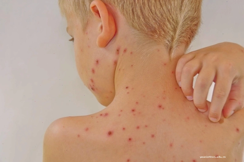 Triệu chứng điển hình của bệnh nổi mề đay quanh cổ