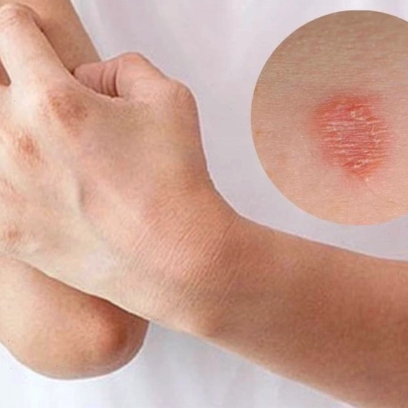 Triệu chứng điển hình của nấm mèo ở người với mảng đỏ, bong tróc và ngứa