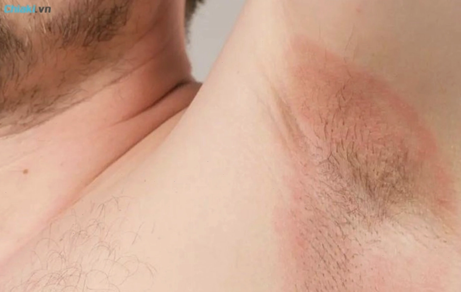 Triệu chứng hăm ở nách người lớn