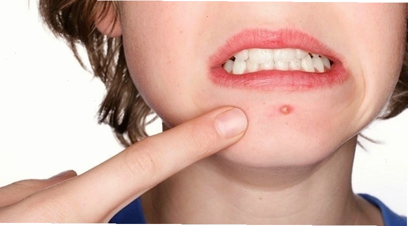 Triệu chứng, nguyên nhân và cách điều trị nóng gan nổi mụn