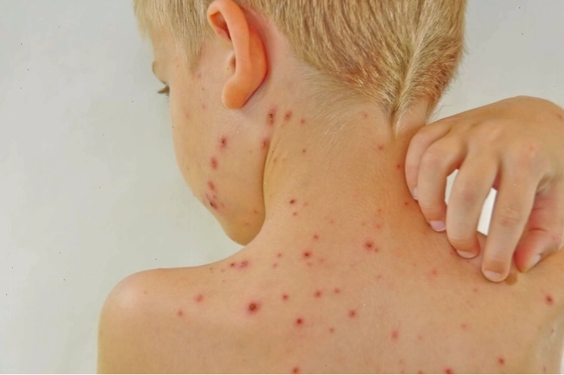 Triệu chứng nổi mẩn đỏ ở cổ kèm theo ngứa và rát