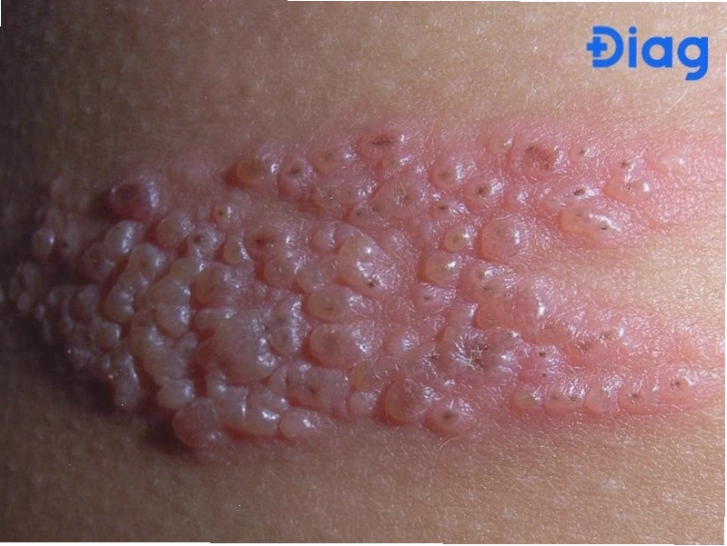 Triệu chứng nổi mụn nước ngứa khắp người do dị ứng hoặc nhiễm trùng