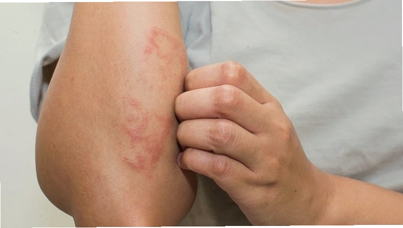 Triệu chứng nổi mụn nước ngứa khắp người là dấu hiệu cần chú ý để xác định nguyên nhân và có hướng xử lý
