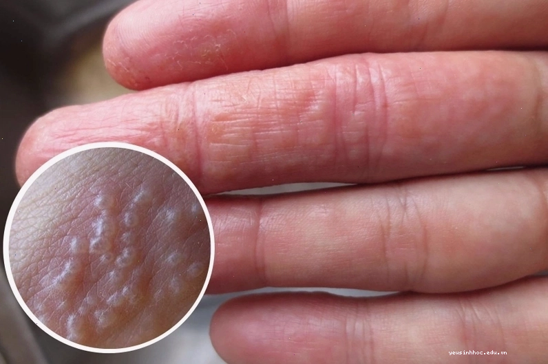 Triệu chứng nổi mụn nước ngứa khắp người là do đâu