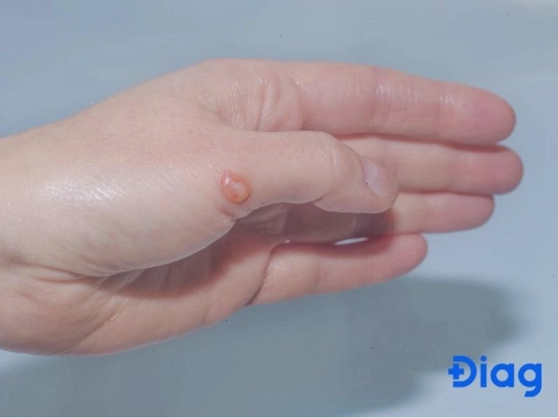 Triệu chứng nổi mụn nước ngứa khắp người và cách xử lý