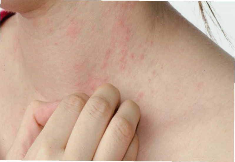 Triệu chứng rôm sảy là những nốt mụn đỏ li ti trên da người lớn