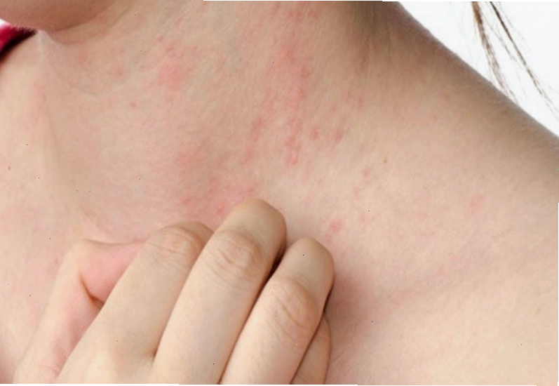 Triệu chứng rôm sảy ở người lớn là những nốt mụn đỏ li ti trên da