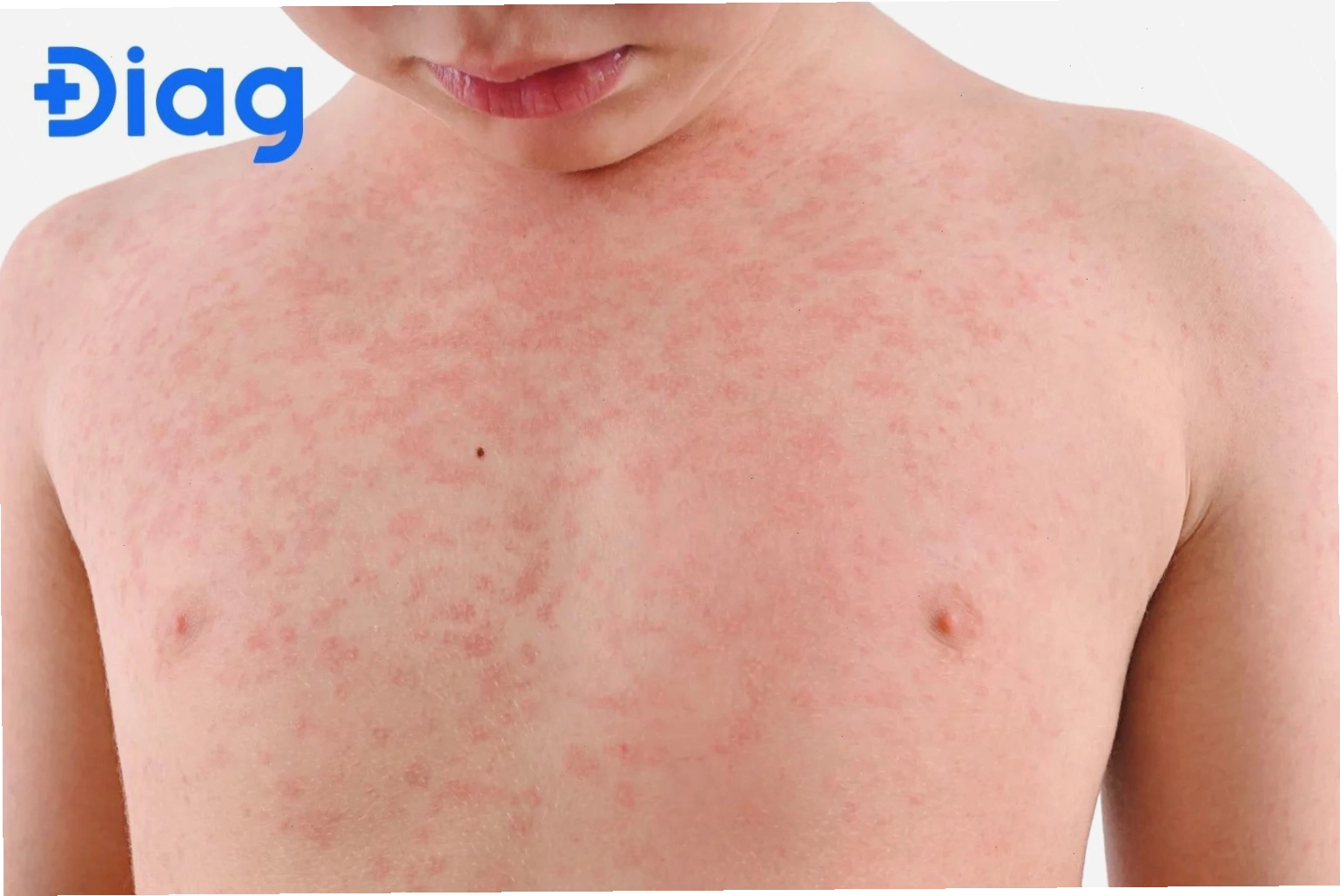 Trời nóng bị ngứa khắp người là hiện tượng khá phổ biến vào mùa hè, có thể xảy ra ở cả người lớn và trẻ nhỏ.