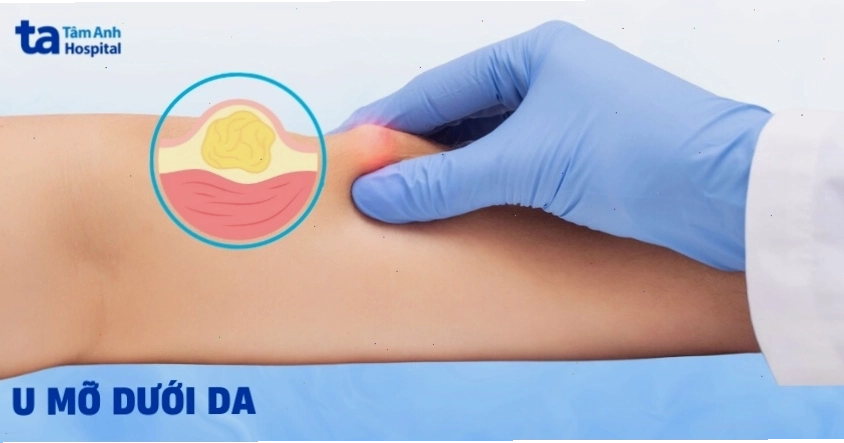 U mỡ dưới da là một trong những nguyên nhân phổ biến gây nổi cục cứng