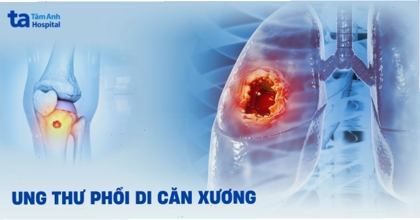 Ung thư phổi di căn xương