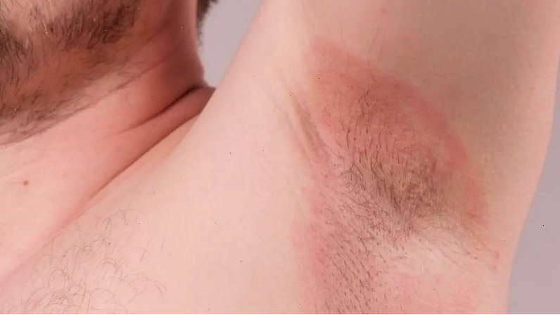 Vệ sinh không đúng cách làm tăng nguy cơ mắc bệnh da liễu bao gồm cả hăm da