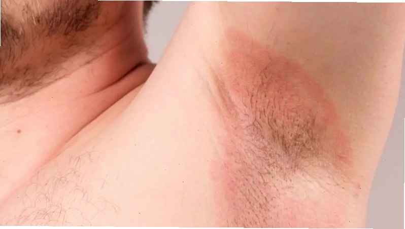 Vệ sinh không đúng cách làm tăng nguy cơ mắc bệnh da liễu bao gồm cả hăm da