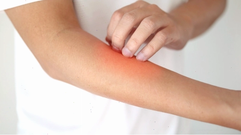 Vết cắn của bọ nhảy gây ngứa dữ dội và sưng đỏ trên da người