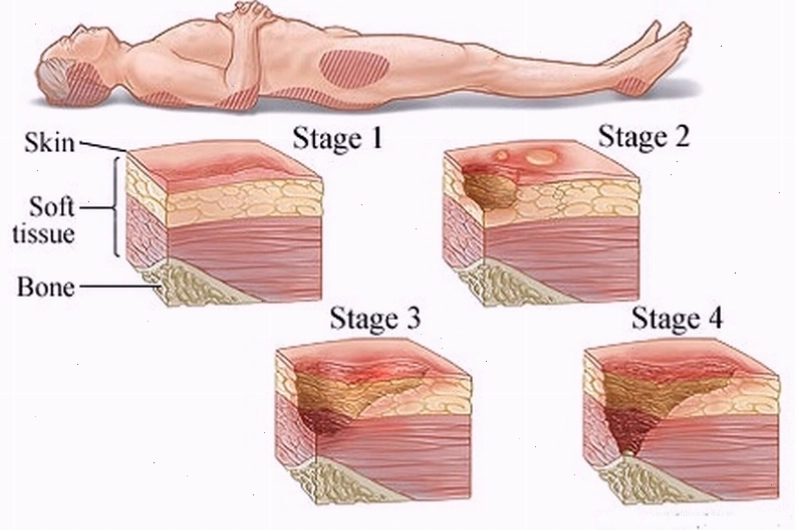 Vết loét tì đè giai đoạn đầu với vùng da đỏ và rát
