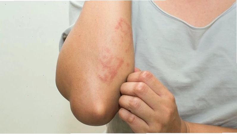 Viêm da cơ địa có thể gặp triệu chứng nổi mẩn đỏ kèm theo ngứa