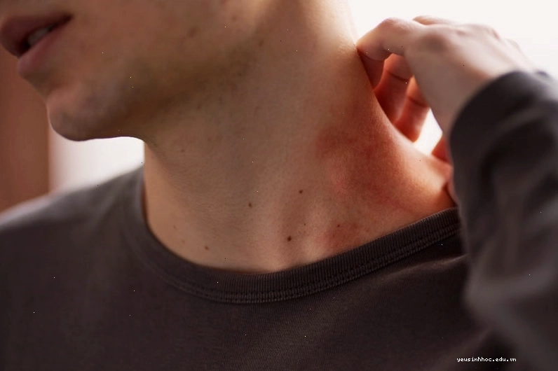 Viêm da cơ địa có thể liên quan đến dị ứng và thay đổi thời tiết