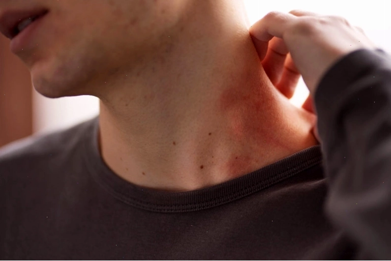 Viêm da cơ địa có thể liên quan đến dị ứng và thay đổi thời tiết