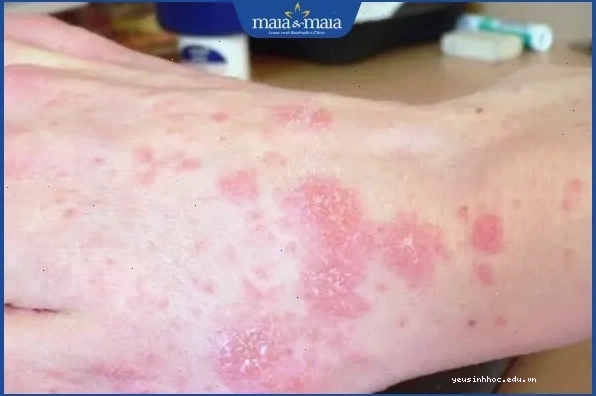 Viêm da gây nổi mụn nước