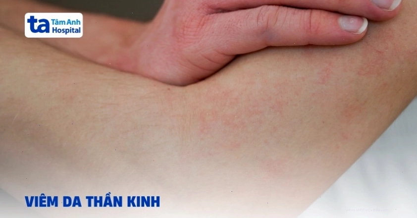 Viêm da thần kinh: Tìm hiểu nguyên nhân và cách điều trị