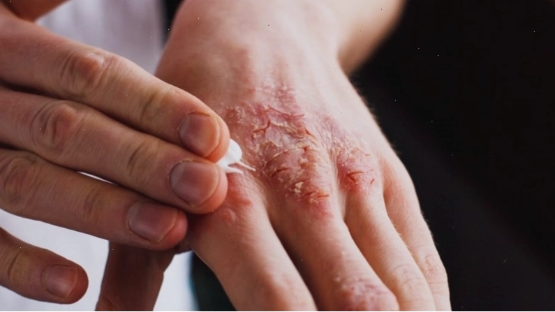 Viêm da tiếp xúc do các chất gây kích ứng