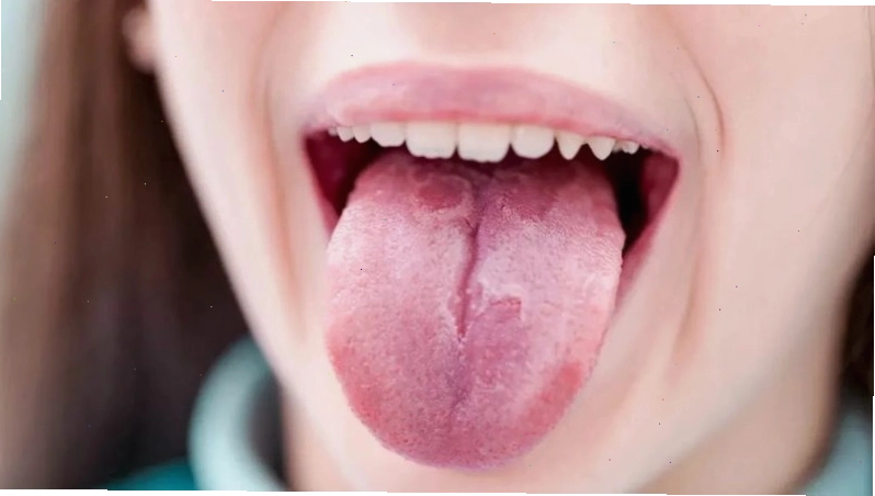 Viêm lưỡi bản đồ được đặc trưng bởi sự biến mất của các nhú lưỡi thành từng mảng