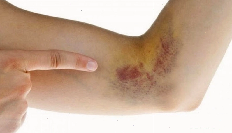 Vỡ mạch máu dưới da tạo nên mảng xuất huyết màu tím đỏ ở người già