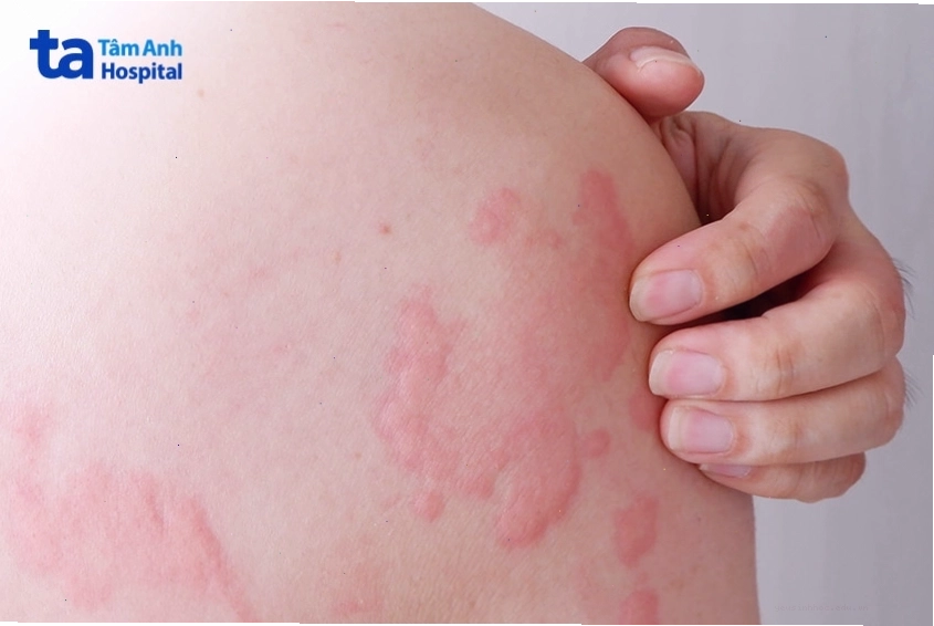 Vùng da bị nổi mẩn đỏ do phản ứng dị ứng hoặc nổi mề đay