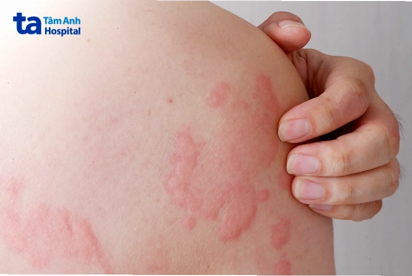 Vùng da bị nổi mẩn đỏ do phản ứng dị ứng hoặc nổi mề đay