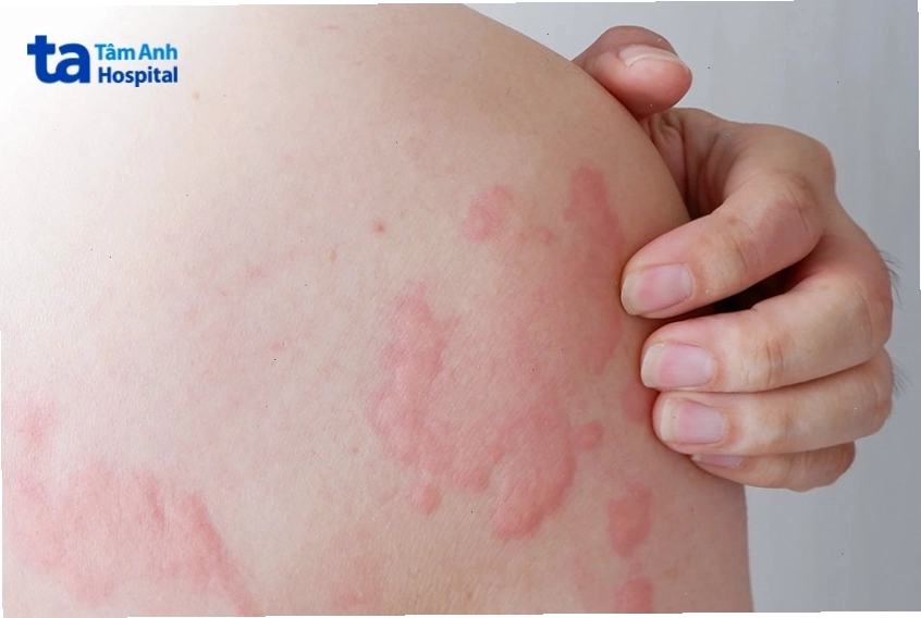 Vùng da bị nổi mẩn đỏ do phản ứng dị ứng hoặc nổi mề đay
