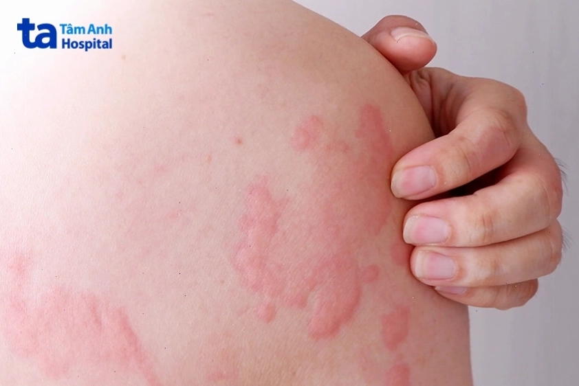 Vùng da bị nổi mẩn đỏ do phản ứng dị ứng hoặc nổi mề đay